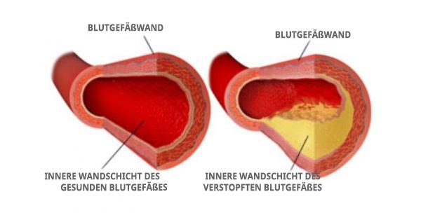 Cholesterin und Blutgefäße