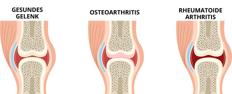 gelenkerkrankungen