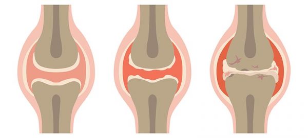 symptome bei arthrose