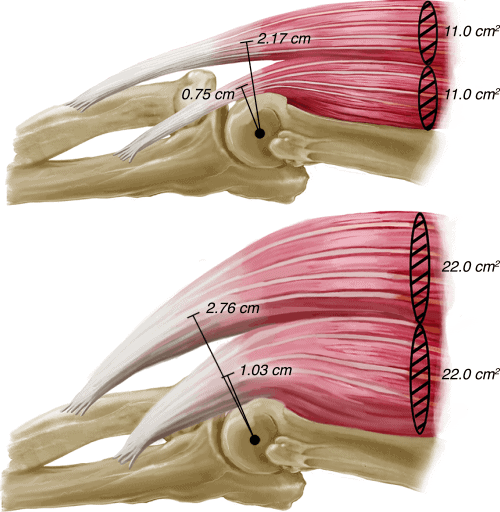 hypertrophie