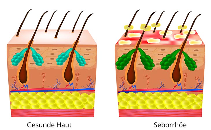 gesunde haut - seborrhöe