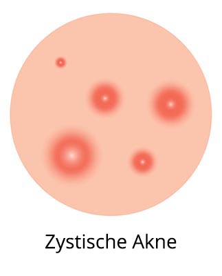 zystische Akne